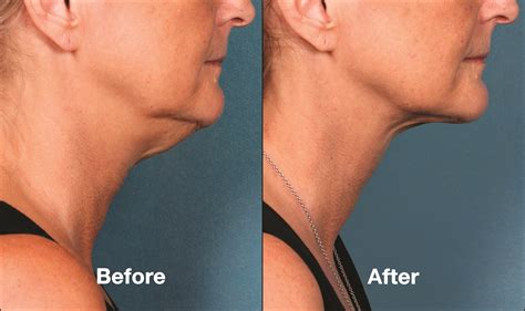 kybella pris|Kybella Injection: Here's How To Get Rid Of That Double Chin.